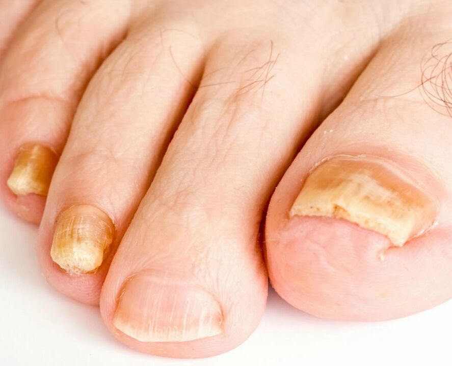 fungi on the nails