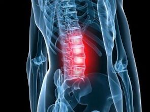 Osteochondrosis of the spine