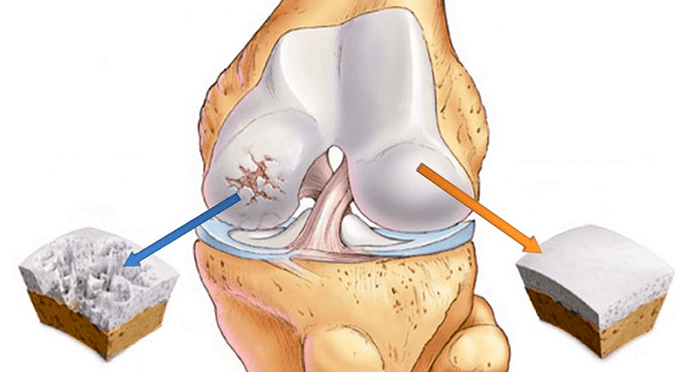 healthy cartilage and cartilage affected by osteoarthritis