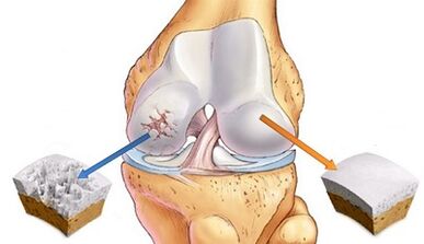 Reasons for developing arthrosis of the joints