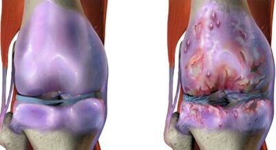The main differences of arthritis and arthritis